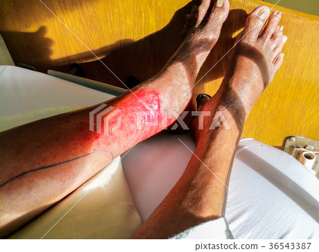 Allergy Medicine, Hand, Human Hand, Human Skin 36543387