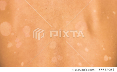Tinea is the back plate is expanding. Tinea is the back plate is expanding. 36658961