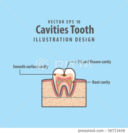 Cavitys tooth structure inside tooth vector 36711648