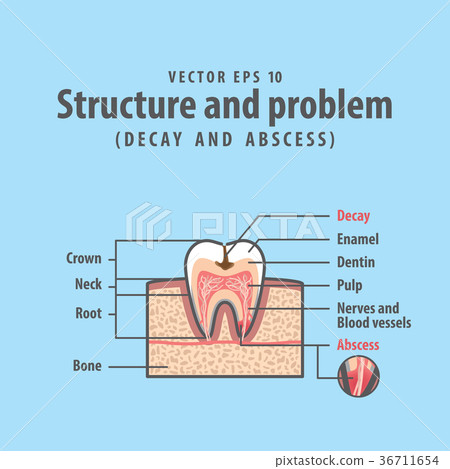 Decay and abscess structure inside tooth vector 36711654