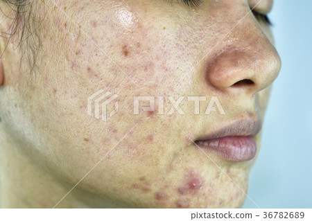Skin problem with acne diseases. Skin problem with acne diseases. 36782689