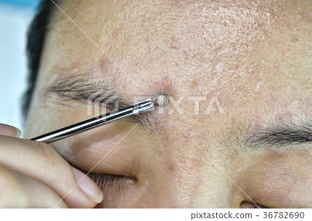 Skin problem with acne diseases. Skin problem with acne diseases. 36782690