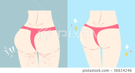 buttocks with plastic surgery concept 36814246