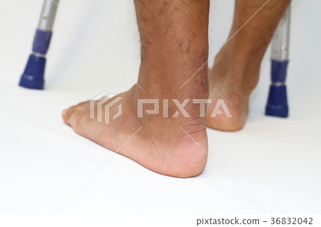 Achilles tendon suture surgery scar and a crutch Achilles tendon suture surgery scar and a crutch 36832042