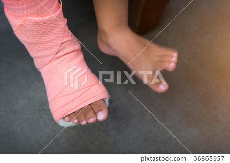 Children wearing a splint of leg broken 36865957