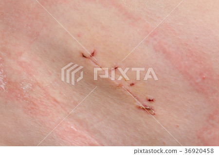 Medicine, appendectomy surgery scar Medicine, appendectomy surgery scar 36920458