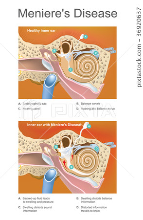 Meniere disease. Illustration. Meniere disease. Illustration. 36920637