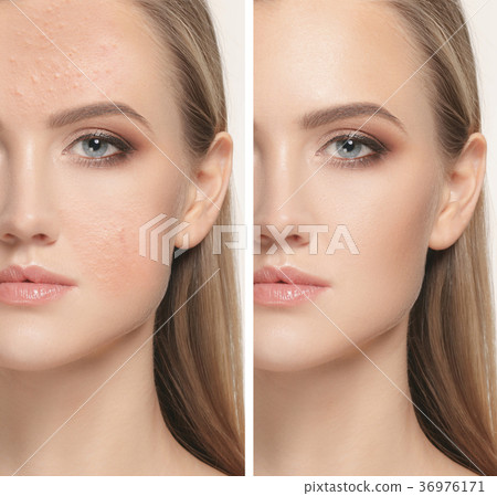 Woman before and after treatment Woman before and after treatment 36976171
