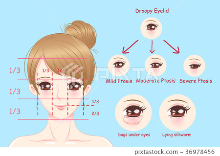 woman with droopy eyelids 36978456