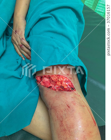 left below the knee wound 37016157
