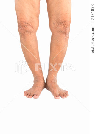 Elderly woman Varus deformity or bow legs Elderly woman Varus deformity or bow legs 37124058