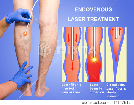 Varicose Veins and laser 37157612