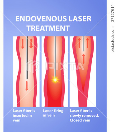 Varicose Veins and laser Varicose Veins and laser 37157614