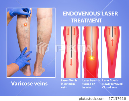 Varicose Veins and laser 37157616