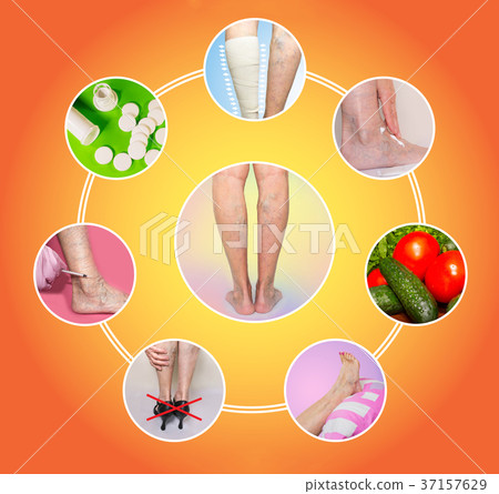 Treatment of varicose veins 37157629