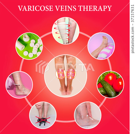 Treatment of varicose veins 37157631