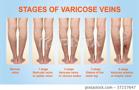 Varicose veins on a female senior leg 37157647