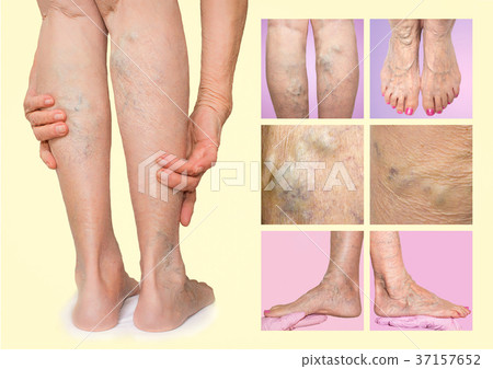 Painful varicose veins,,spider veins, varices on a Painful varicose veins,,spider veins, varices on a 37157652