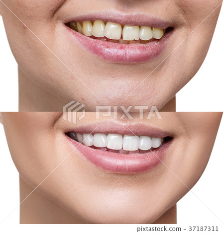 Teeth of young woman before and after whitening. Teeth of young woman before and after whitening. 37187311