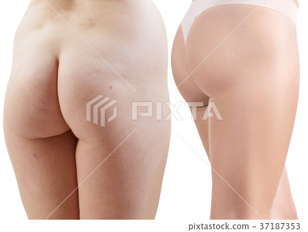 Female buttocks before and after spont and 37187353