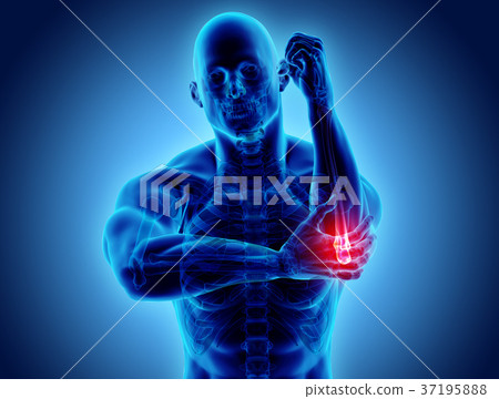 3d Illustration Of Human Elbow Injury. - Stock Illustration [37195888 ...