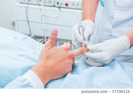 laser treatment of scar on the man's finger 37196316