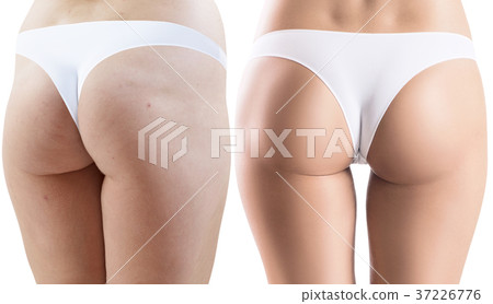 Female buttocks before and after spont and 37226776