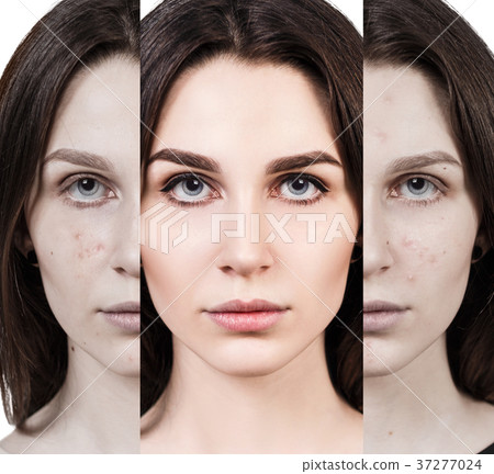 Woman rebirth from bad acne skin to perfect. Woman rebirth from bad acne skin to perfect. 37277024