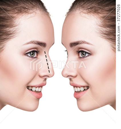 Female nose before and after cosmetic surgery Female nose before and after cosmetic surgery 37277026