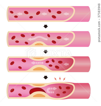 動脈硬化的發病和進展的例證(沒有字母) 動脈硬化的發病和進展的例證(沒有字母) 37383948