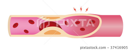 動脈(血管),其血流被血栓阻塞 動脈(血管),其血流被血栓阻塞 37416905