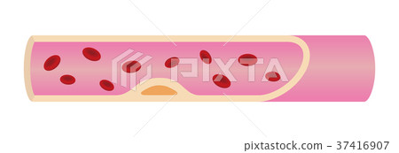 Artery (blood vessels) that caused arteriosclerosis (early) 37416907