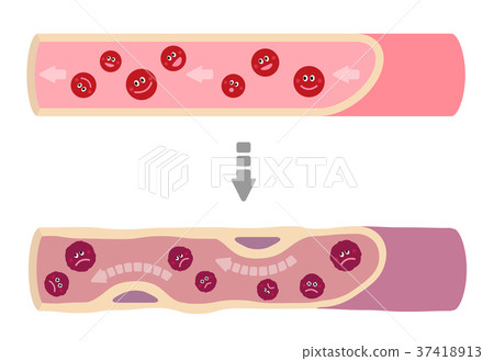 Illustration that healthy blood vessels of... - Stock Illustration ...