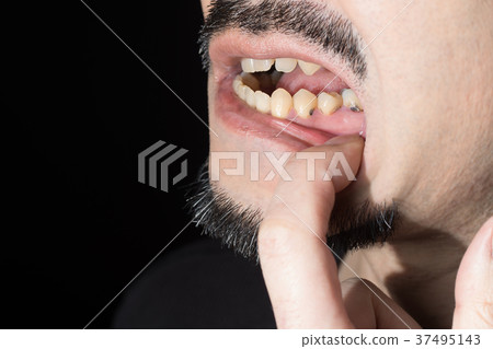 齲齒 齲齒 37495143