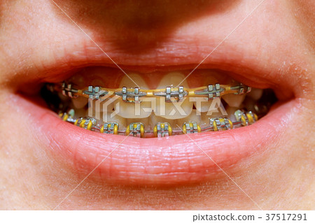 Beautiful macro shot of white teeth with braces. Beautiful macro shot of white teeth with braces. 37517291