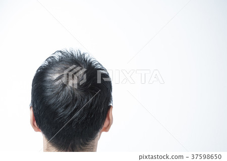 中年男士稀發 中年男士稀發 37598650