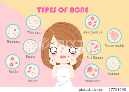 girl with types of acne 37701098