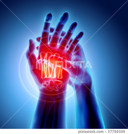 Palm painful - skeleton x-ray, Medical concept. 37789309