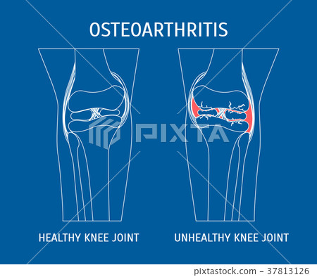Thin Line Osteoarthritis Healthy and Unhealthy 37813126