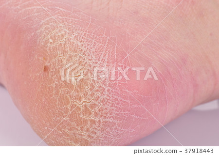 Dry skin on feet Dry skin on feet 37918443