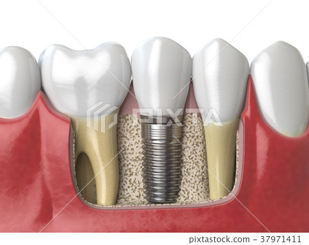 Anatomy of healthy teeth and tooth dental implant Anatomy of healthy teeth and tooth dental implant 37971411