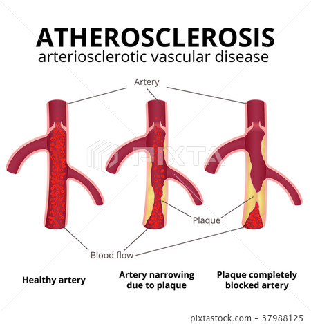 coronary artery disease - Stock Illustration [37988125] - PIXTA