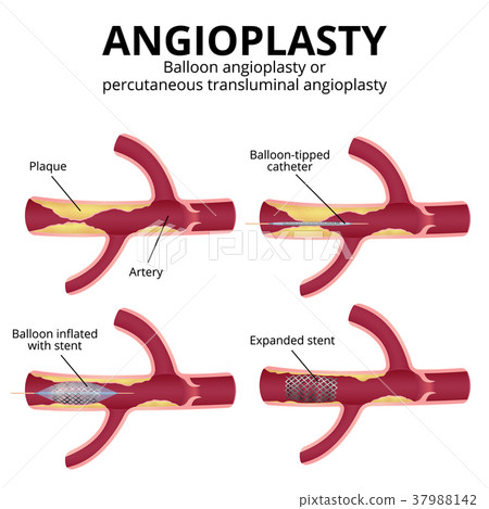 balloon angioplasty 37988142
