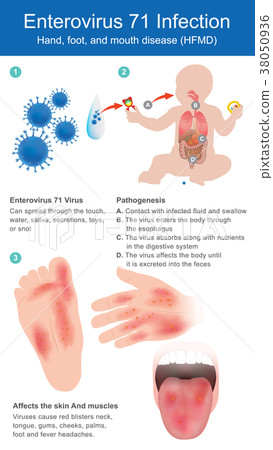 Enterovirus 71 Infection..Hand, foot, and mouth. - Stock Illustration ...