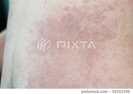 Close up Allergy rash on a man skin 38101540