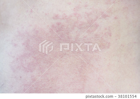 Close up Allergy rash on a man skin Close up Allergy rash on a man skin 38101554