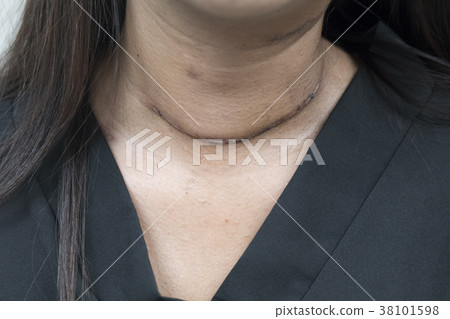 Post surgical scar on woman neck Post surgical scar on woman neck 38101598