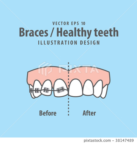 Braces-Healthy teeth illustration vector Braces-Healthy teeth illustration vector 38147489
