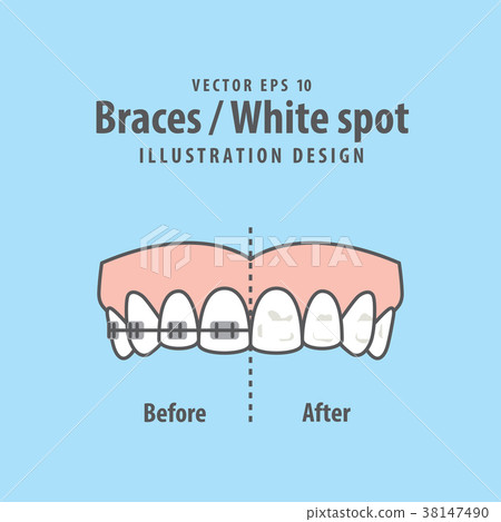 Braces-White spot illustration vector Braces-White spot illustration vector 38147490