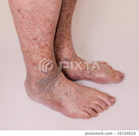 Close-up of skin with varicose veins 38184620